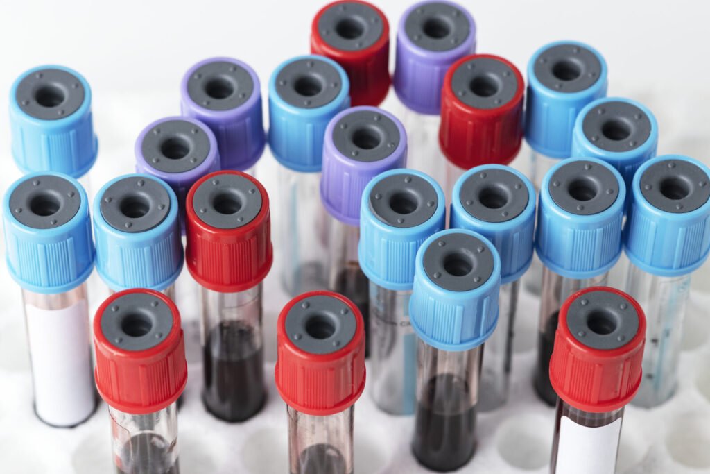 Blood samples in a test tube rack in a hospital lab